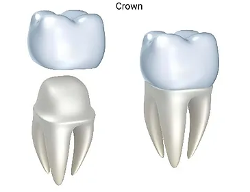 Affordable-Dental-Crowns-in-Lynnwood-WA.png