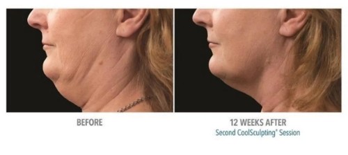 CoolSculpting Before and After Pictures