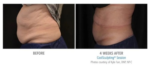 CoolSculpting-Therapy-Results.jpg