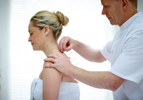 Acupuncture for Pain Relief Physio Village Clinics in Brampton and Oakville