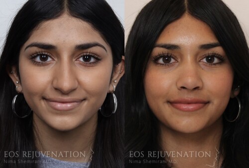 Blepharoplasty-Beverly-Hills.jpg