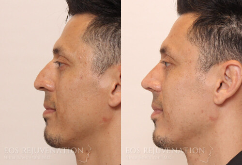 Blepharoplasty.jpeg
