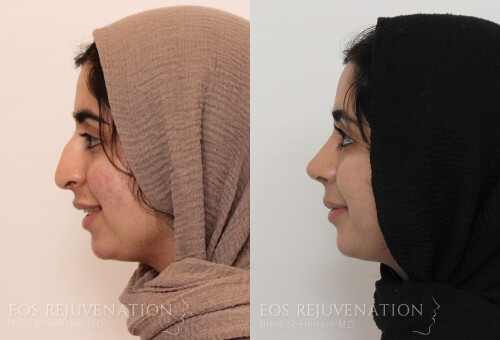Facelift.jpeg