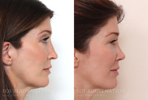 Neck-Lift.jpeg
