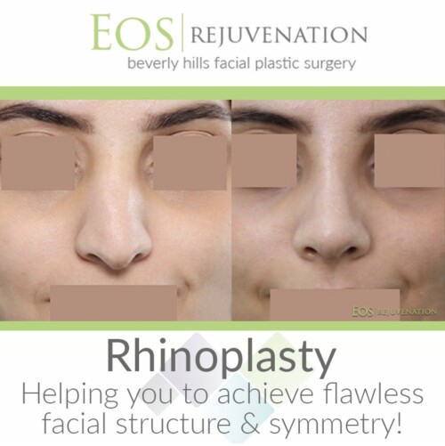 Revision-Rhinoplasty-Beverly-Hills.jpg